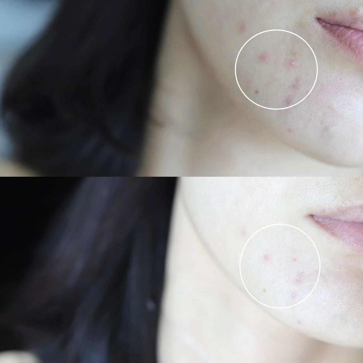 快速去痘 淡化痘印✨| BR:LAB 小藍瓶淨痘精華升級版🚨BR:LAB SUPER SPOT REMOVER PRO🩵