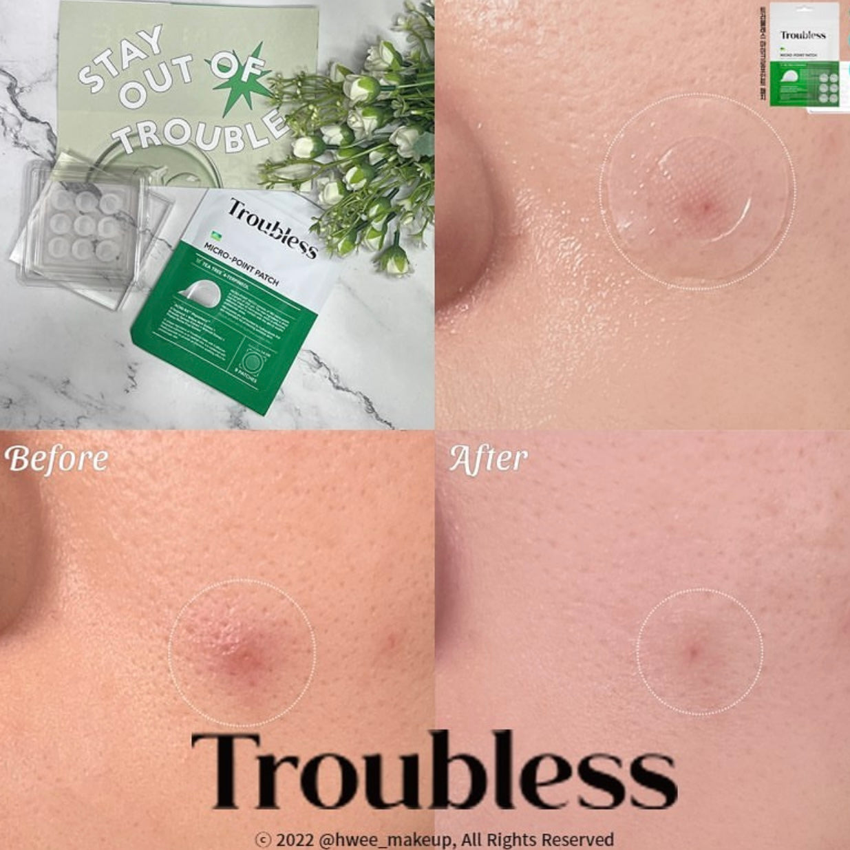 高效極透薄❤️🔥| TROUBLESS超隱形多重茶樹痘痘貼 96片裝| TROUBLESS The Signature Invisible Spot Patch🌿