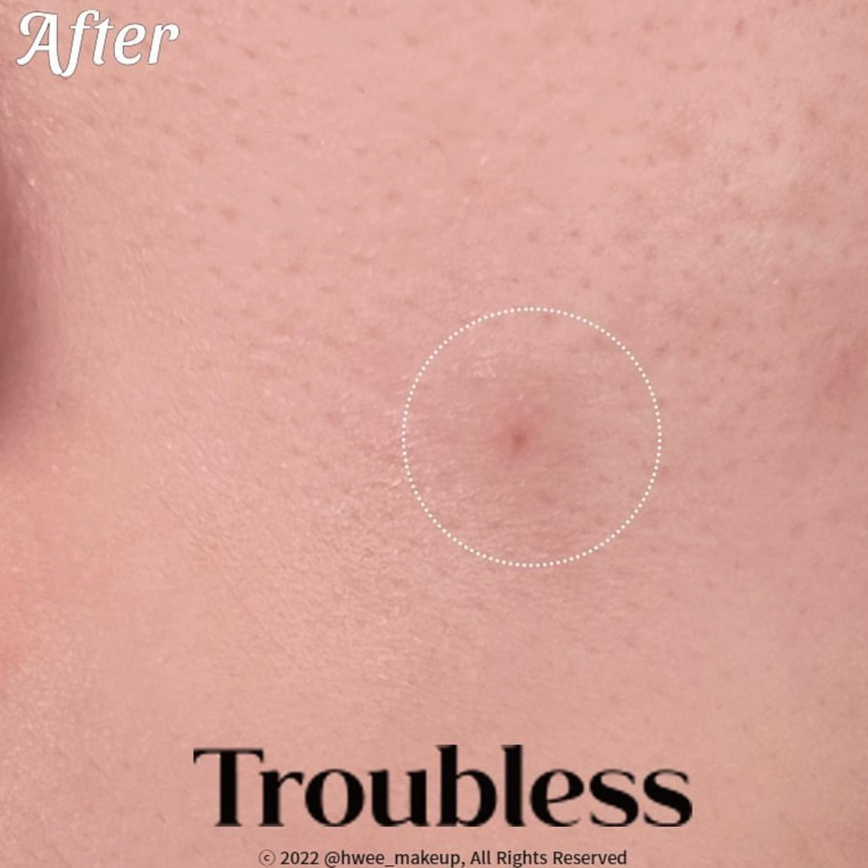 高效極透薄❤️🔥| TROUBLESS超隱形多重茶樹痘痘貼 96片裝| TROUBLESS The Signature Invisible Spot Patch🌿