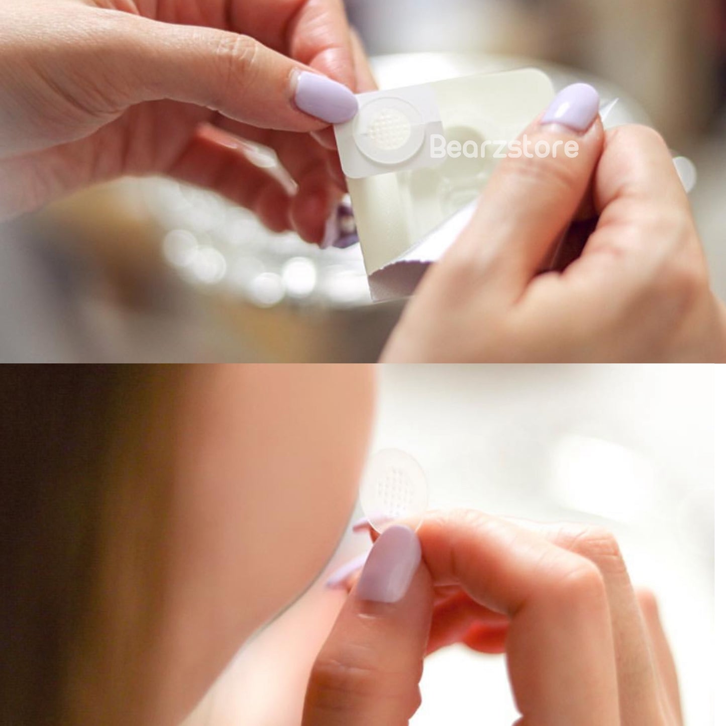 ACROPASS微針肌膚急救暗瘡貼 AC Care Essence Patch | 針對含膿或紅腫石頭瘡✨