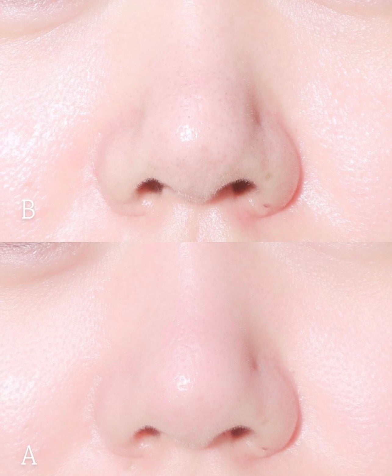 肌膚即時降溫❄️| ILSO雙頭冰鎮緊緻消腫按摩儀🩵| ILSO DUAL COOLING MASTER