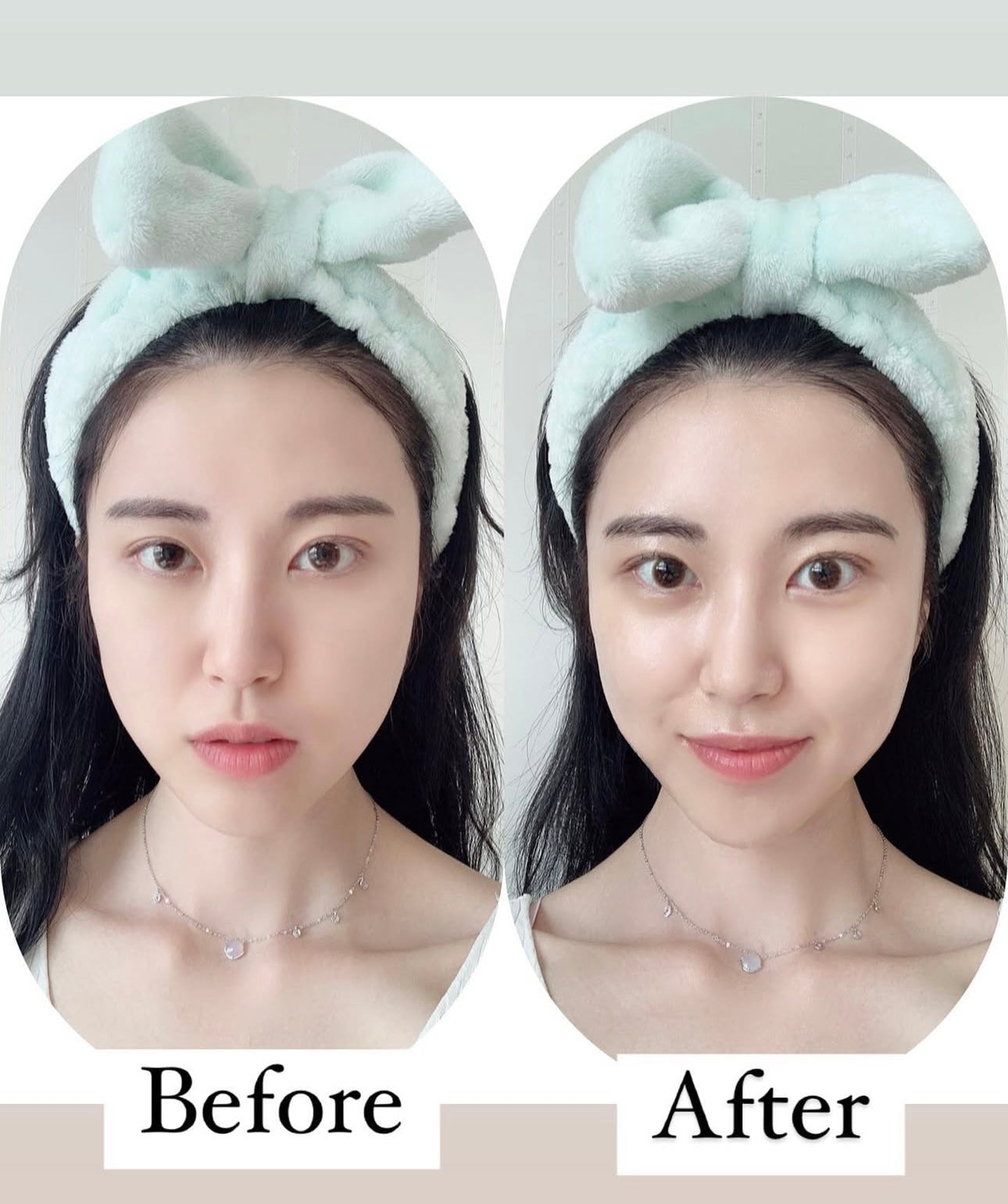 保濕、舒緩、修護|SKIN1004積雪草玻尿酸深層保濕爽膚水🩵|推薦乾敏肌