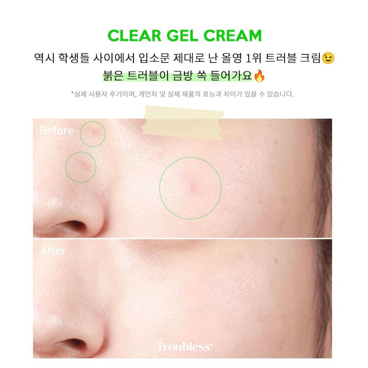 韓國暗瘡專家品牌🌟 |Troubless 多重茶樹抗痘去印霜Troubless Clear Gel Cream 🌿