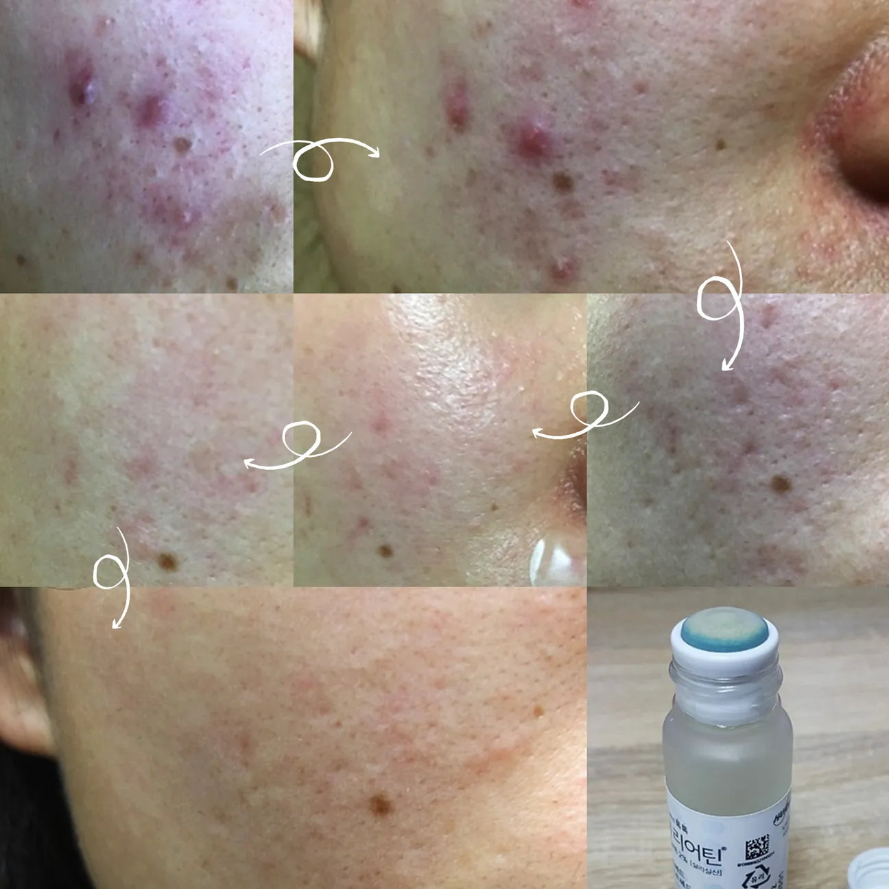 韓國藥房專賣🤍Handok 韓國國民去痘痘水| Handok Topical Acne Treatment