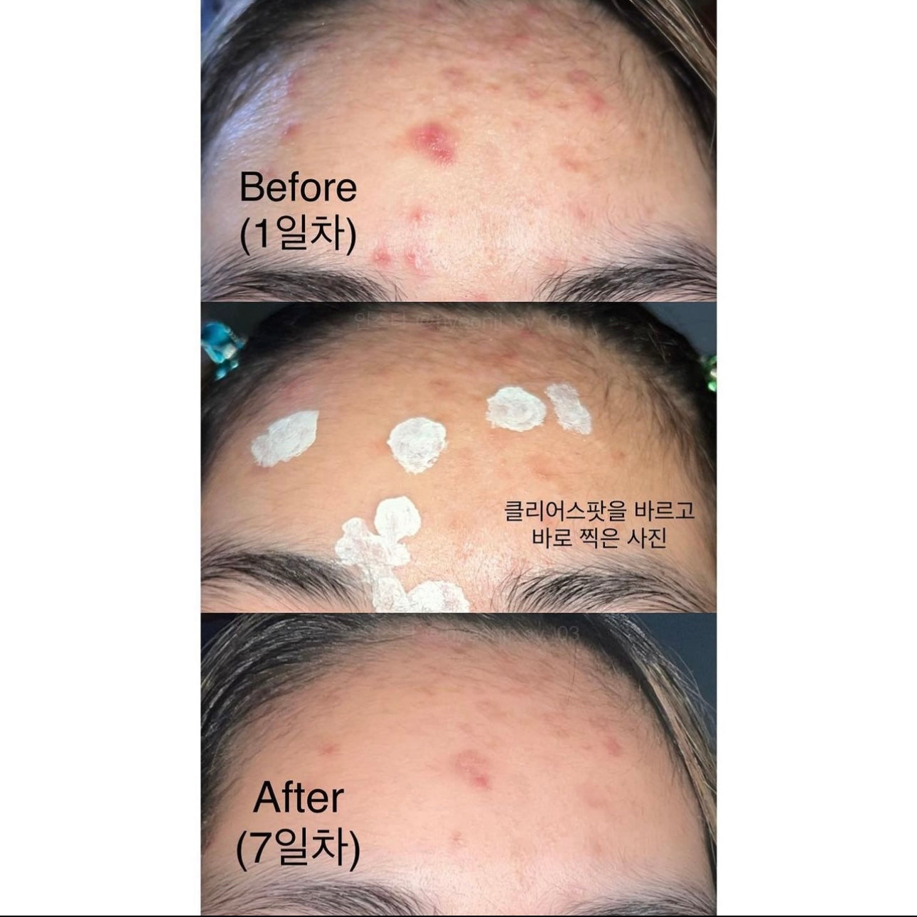 SOMEBYMI 三酸抗痘淡化痘疤綠修護膏 🌿Miracle AC Clear Spot Treatment