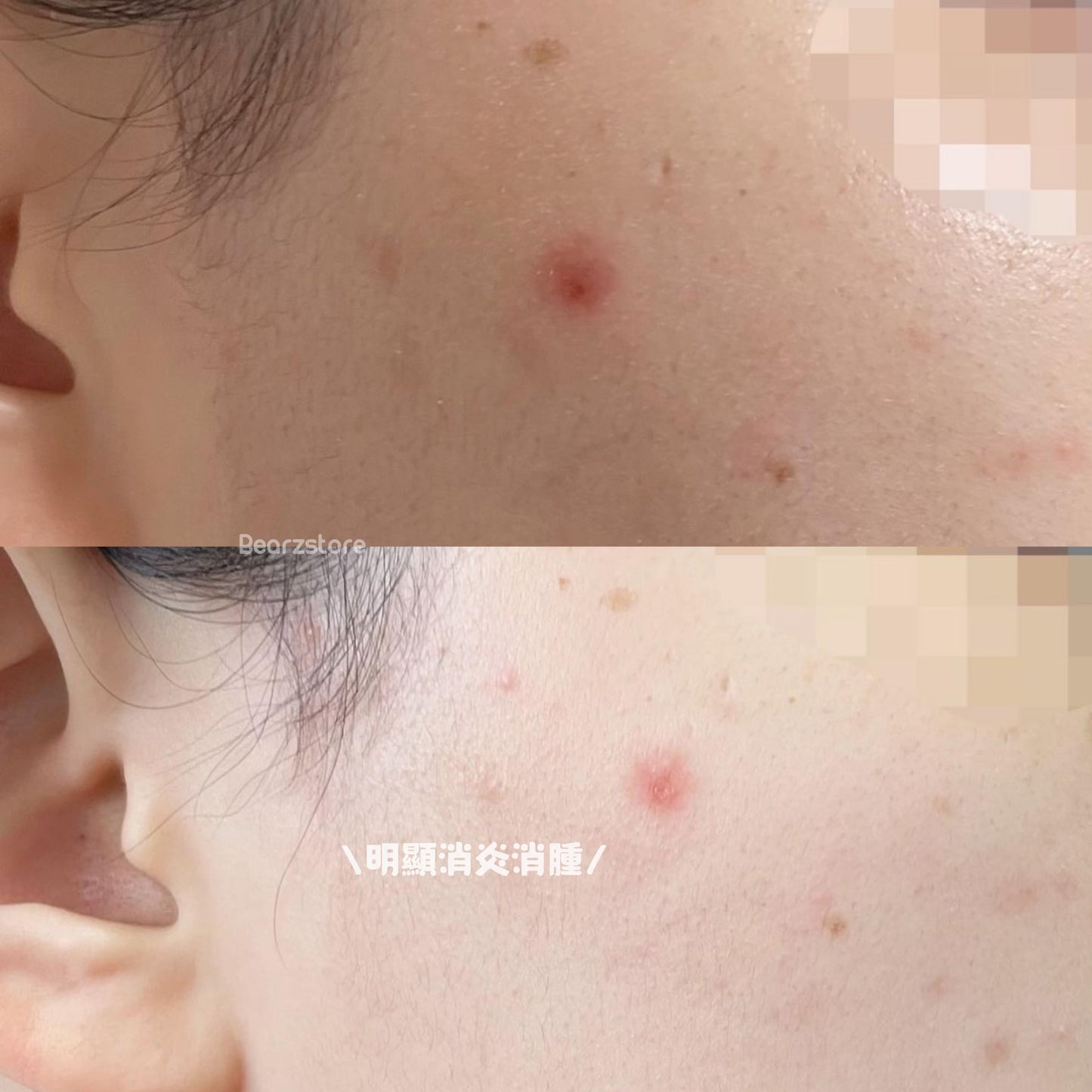 SOMEBYMI 三酸抗痘淡化痘疤綠修護膏 🌿Miracle AC Clear Spot Treatment