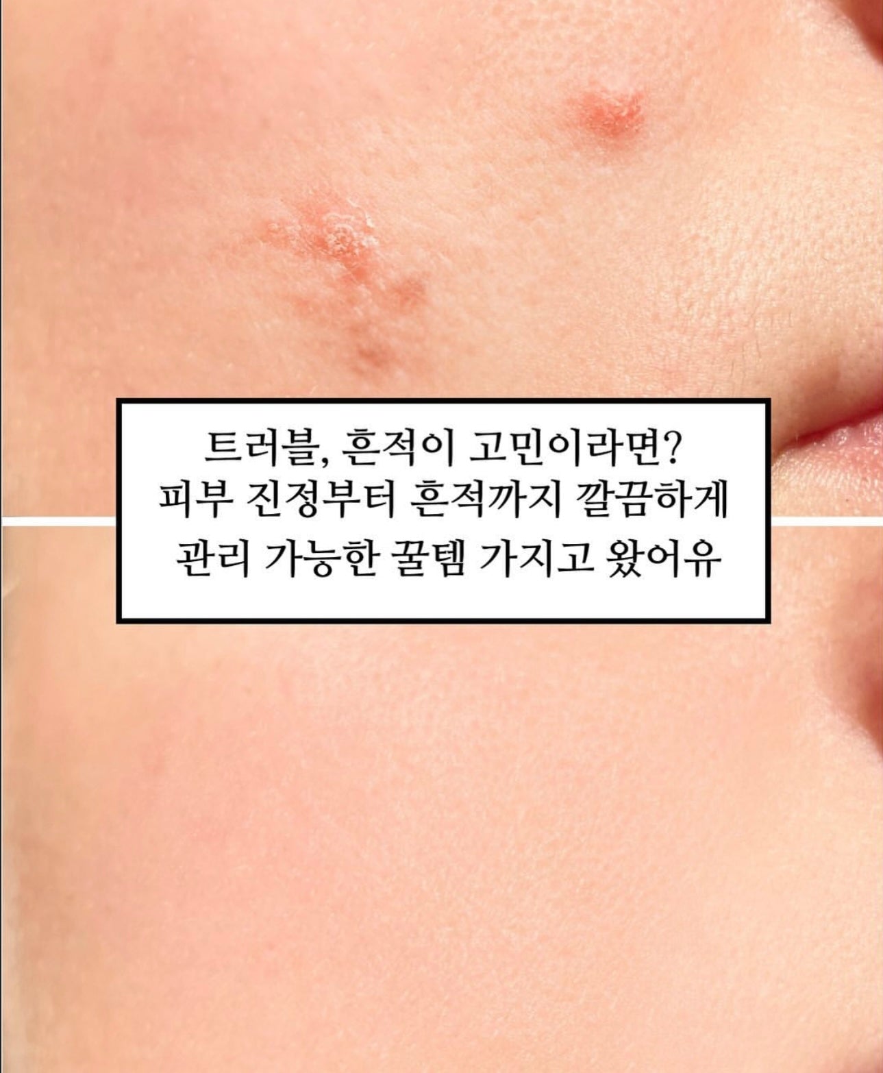 MEDIHEAL 積雪草修復舒緩淡印精華| MEDIHEAL Madecassoside Blemish Pad💡美白去印減暗沉護膚