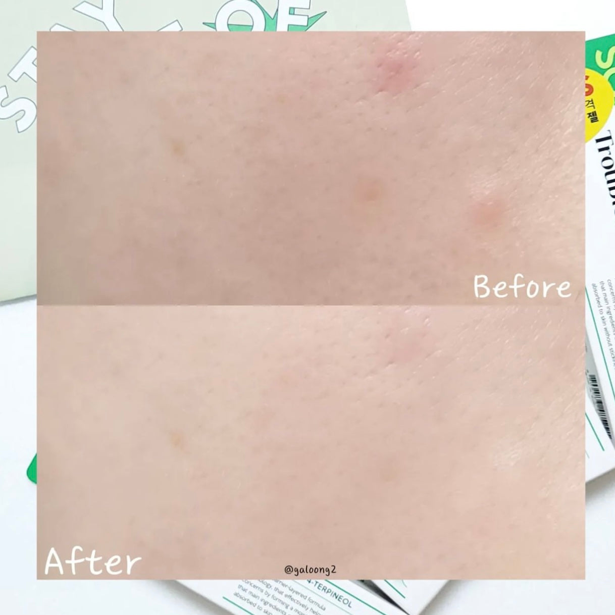 韓國暗瘡專家品牌🌟 |Troubless 多重茶樹抗痘去印霜Troubless Clear Gel Cream 🌿