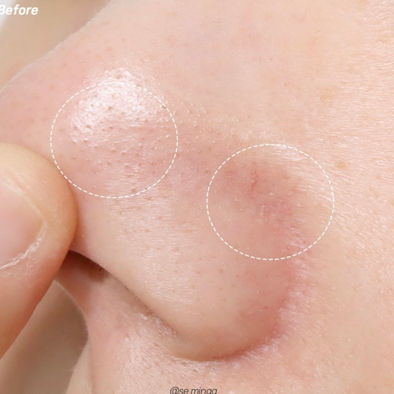 黑頭粉刺必試款🧹| Ilso溶解皮脂收毛孔導出液 Ilso Super Melting Sebum Softener✨