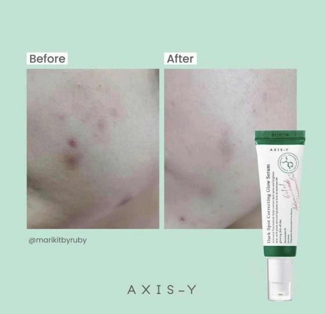 超推🌟陳年舊印想清走佢 一定要試佢手🖖🏻 AXIS-Y Dark Spot Correcting Glow Serum亮白橡皮擦精華🌿韓國推出至今已銷售破百萬✨
