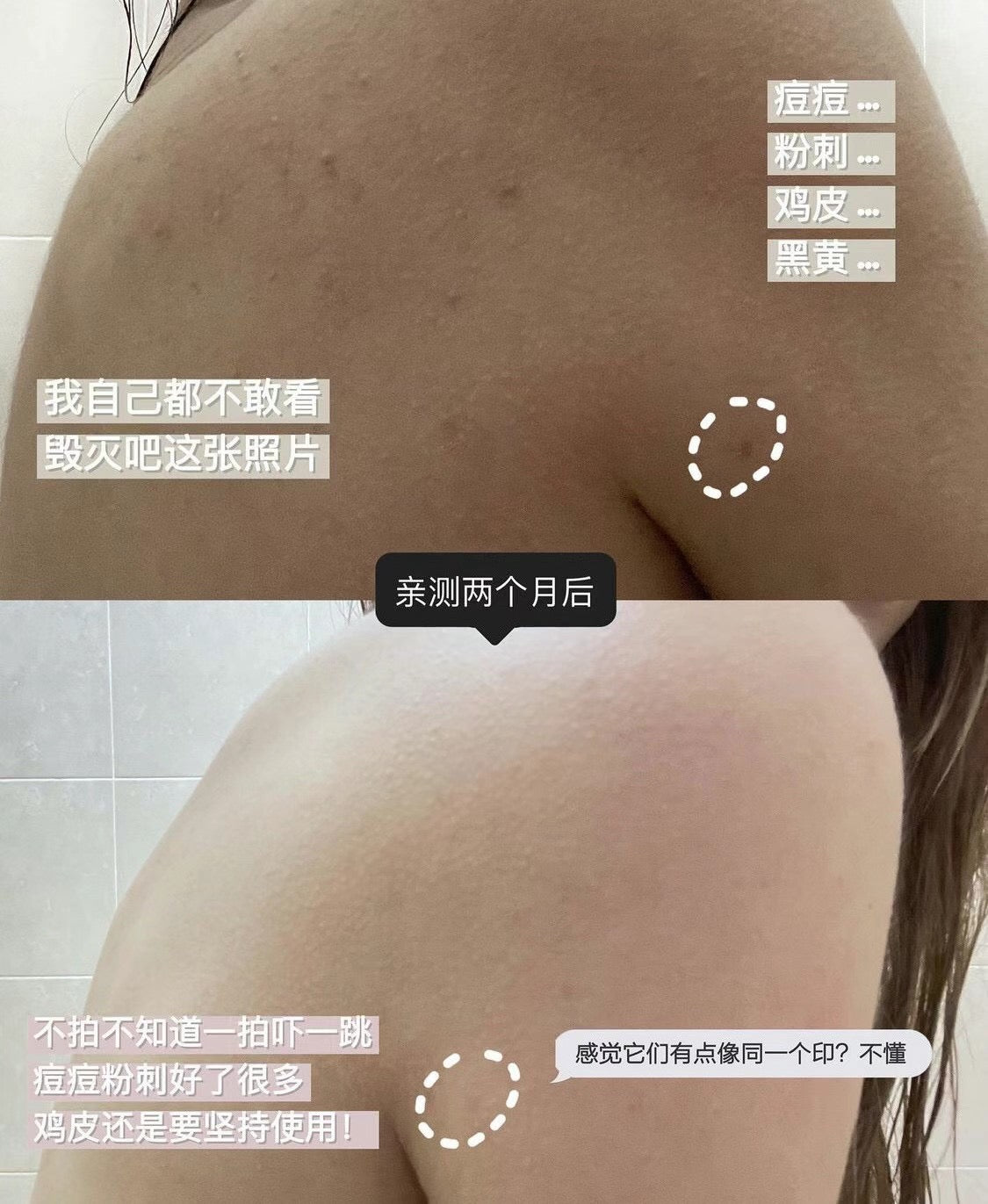 MERPHIL AC+MAGIC CLEANSER 身體消炎去痘沐浴露 ✨