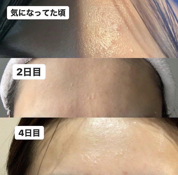 回購率高達95%!韓國小眾護膚品牌🇰🇷| Anua 77% 魚腥草去暗粒爽膚水💚| Heartleaf 77% Soothing Toner