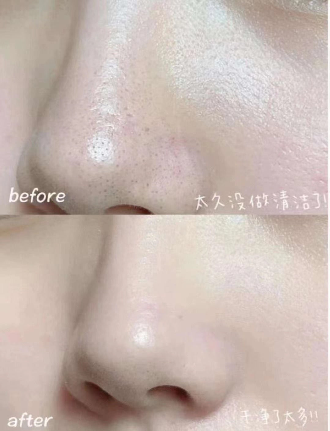 韓國RNW 去黑頭 粉刺 痘痘蟎蟲 收縮毛孔鼻貼✨