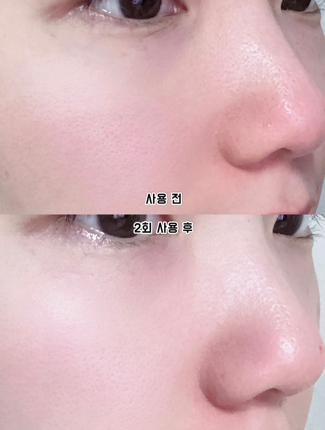 針對毛孔粗大✨CAREPLUS 視黃醇毛孔縮小微針貼片💜| CAREPLUS Retinal Pore Micro Dot Patch