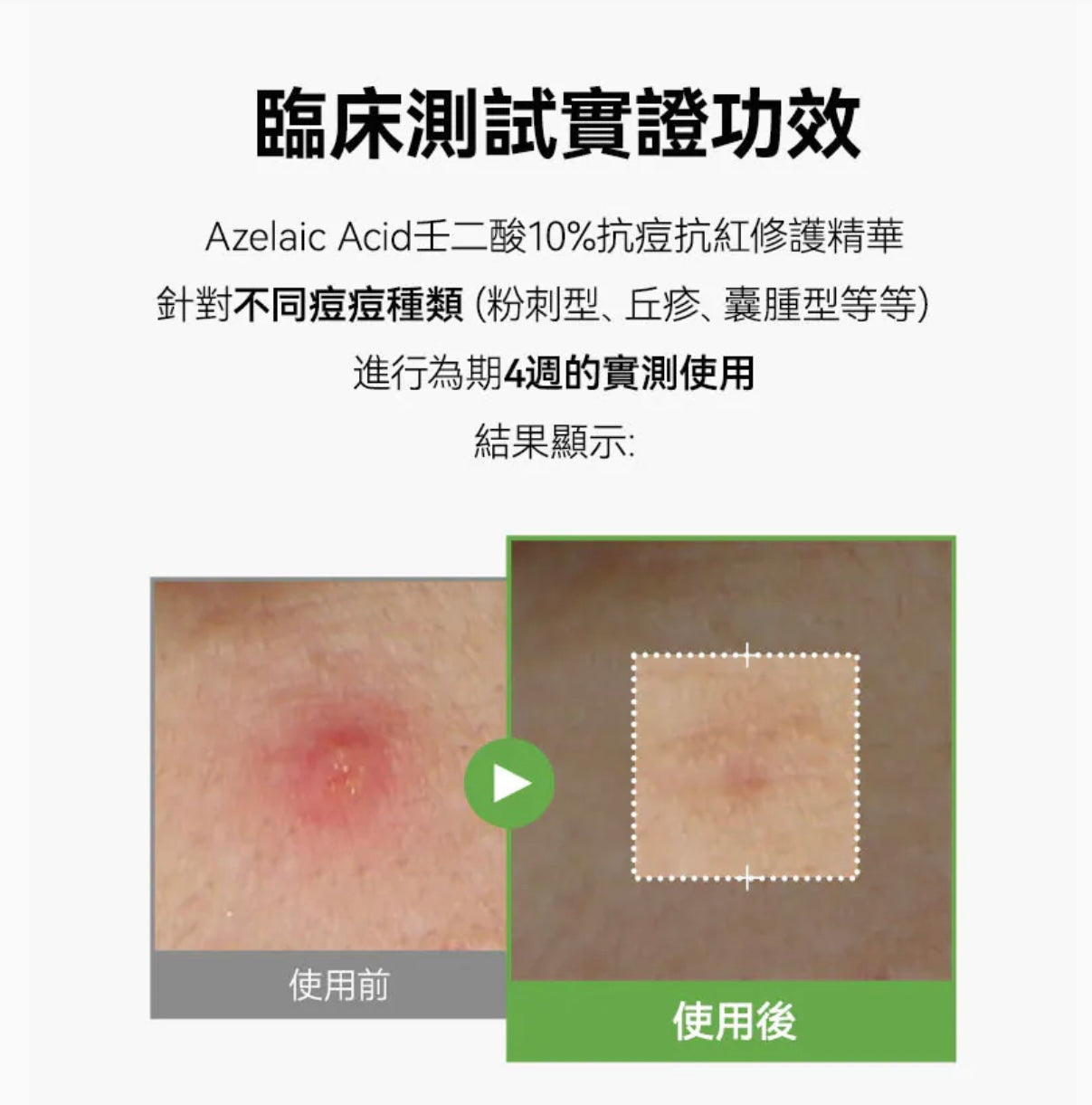Anua Azelaic壬二酸10%抗痘抗紅修護精華💚