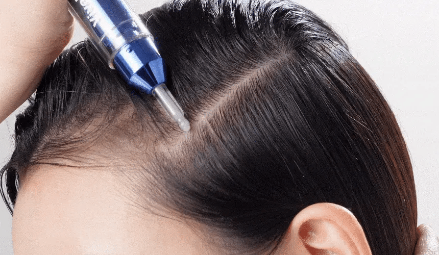 頭皮微針入門首選｜ViveLab 育髮防脫髮安瓶 Spioxyl ReactShot 400👩🏼‍⚕️