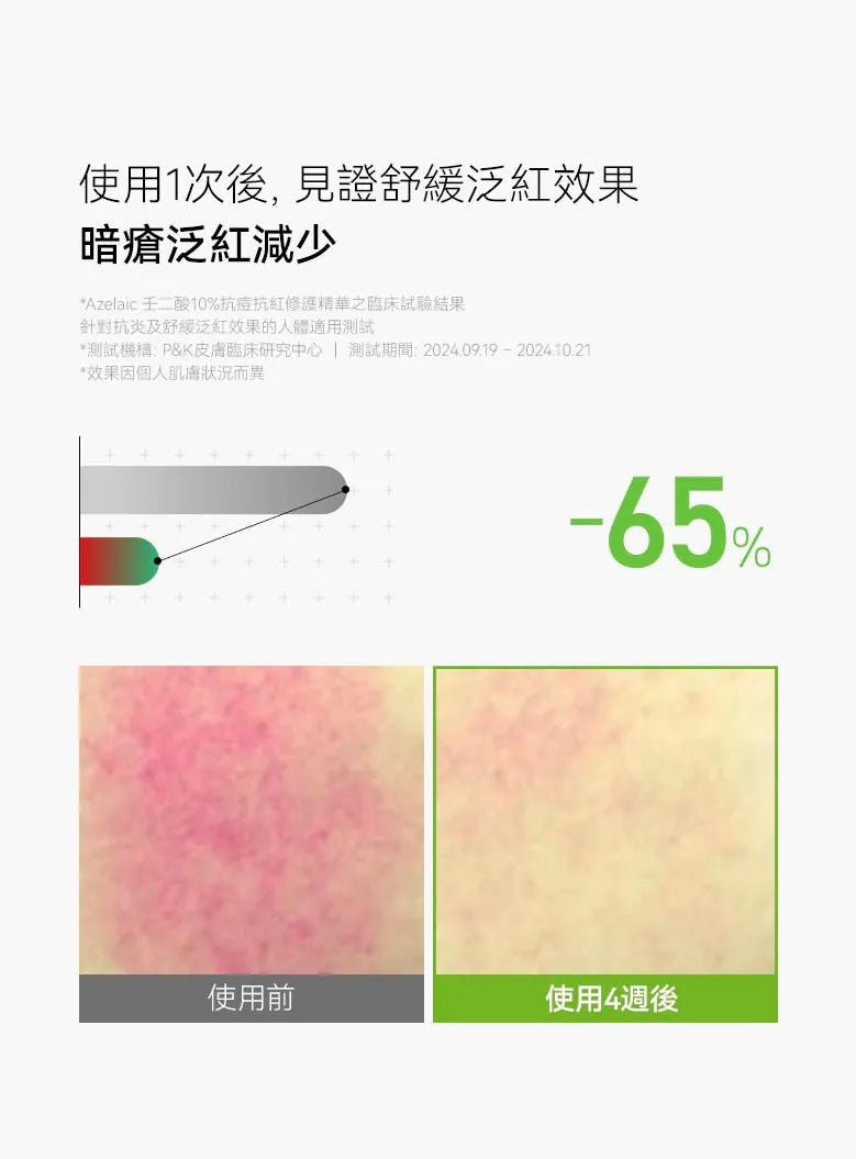 超多客人搵佢🔥告別煩人粉刺、紅疹、痘印⭐️Anua Azelaic壬二酸10%抗痘抗紅修護精華💚 Anua Azelaic Acid 10 Hyaluron Redness Soothing Serum