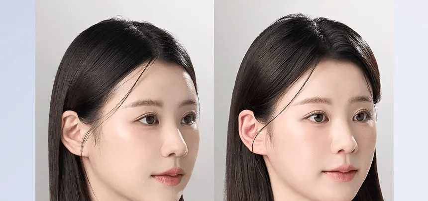 頭皮微針入門首選｜ViveLab 育髮防脫髮安瓶 Spioxyl ReactShot 400👩🏼‍⚕️