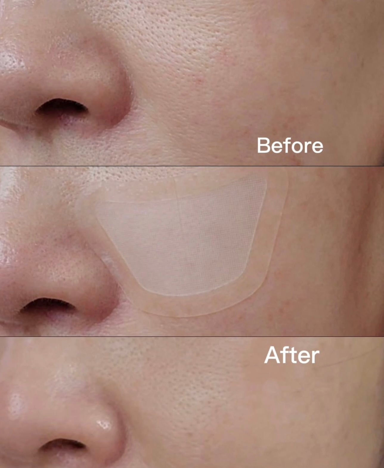 針對毛孔粗大✨CAREPLUS 視黃醇毛孔縮小微針貼片💜| CAREPLUS Retinal Pore Micro Dot Patch