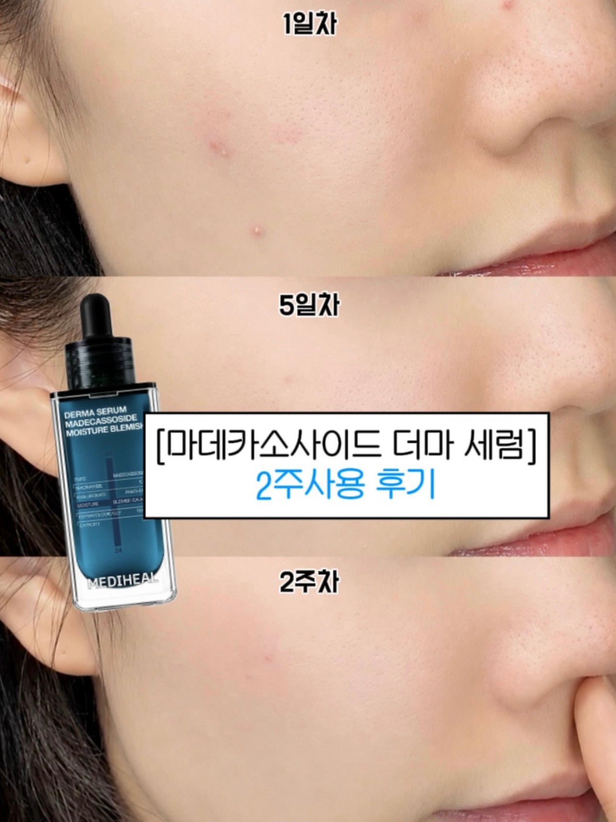 MEDIHEAL x 布丁狗🍮限量聯名✨升級版🔥強效淡印修復痕跡補水精華🩵 DERMA SERUM MADECASSOSIDE
MOISTURE BLEMISH