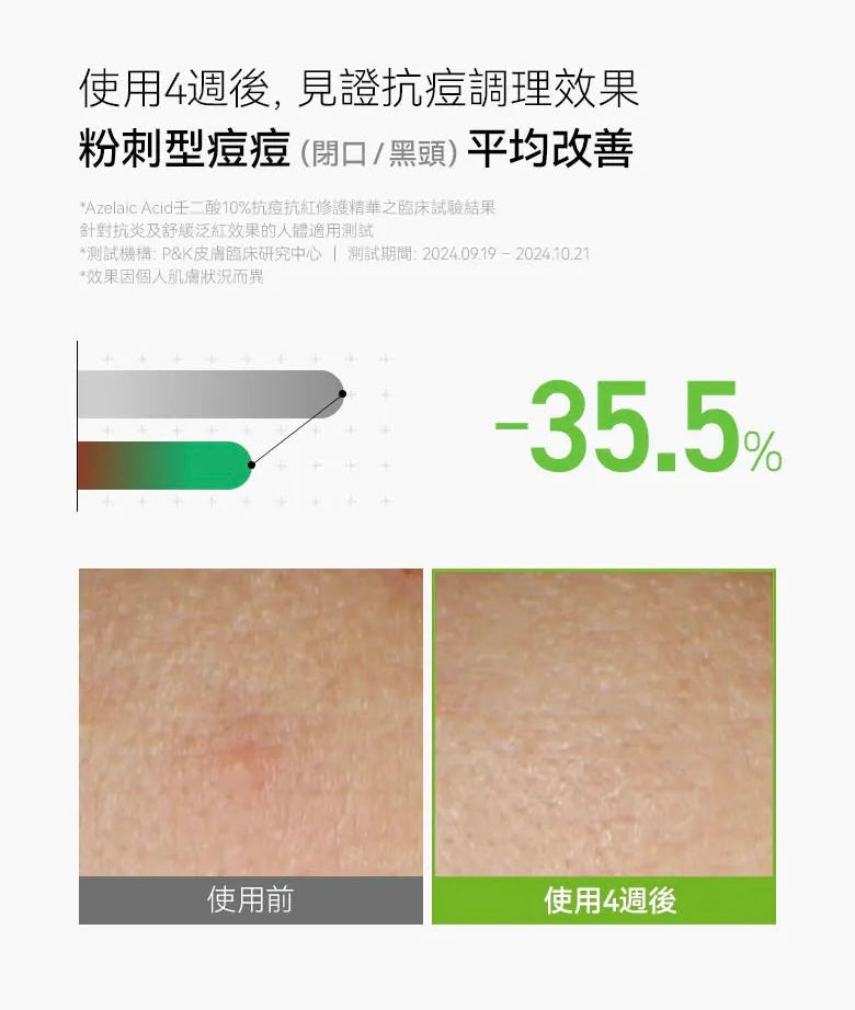 超多客人搵佢🔥告別煩人粉刺、紅疹、痘印⭐️Anua Azelaic壬二酸10%抗痘抗紅修護精華💚 Anua Azelaic Acid 10 Hyaluron Redness Soothing Serum