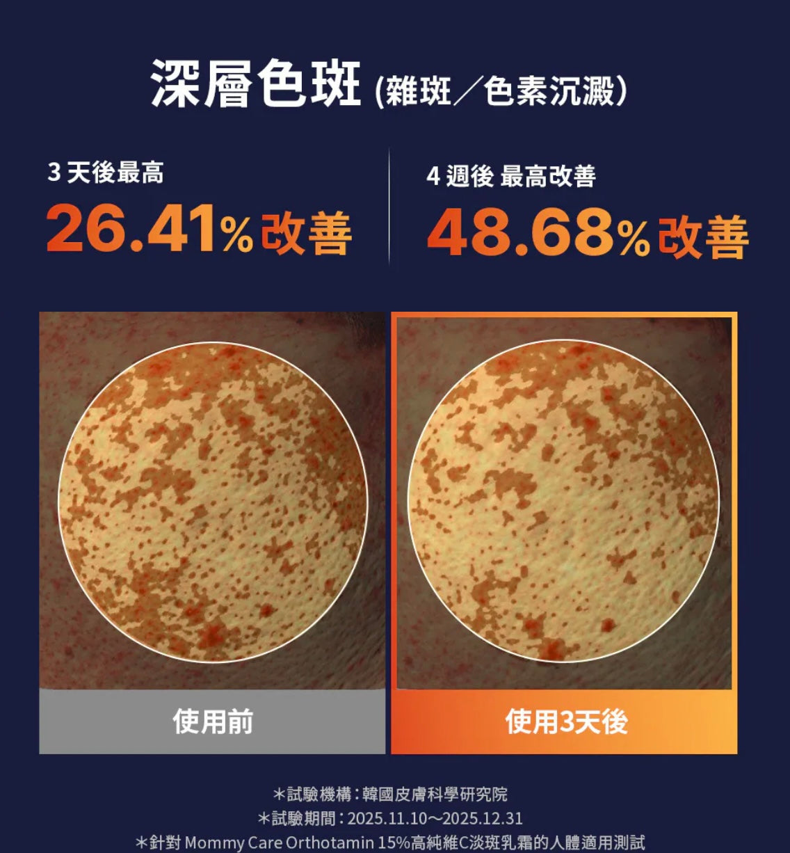 高效溫和✨Mommycare Orthotamin 15高純維C極致淡斑逆齡乳霜 ✨