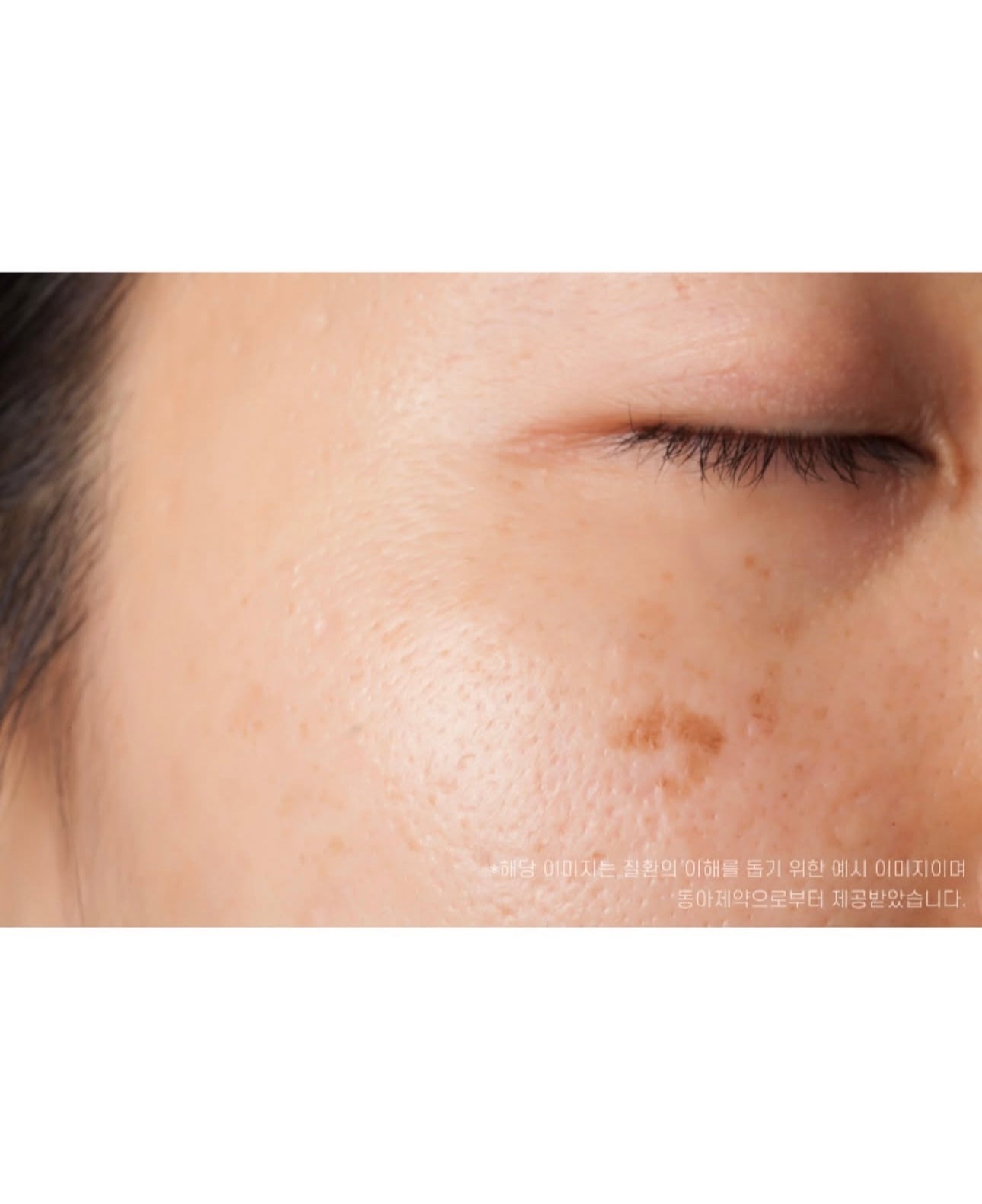 韓國藥房專賣🏥東亞製藥褪黑色素祛斑膏 Dapharm Mela Toning Cream✨