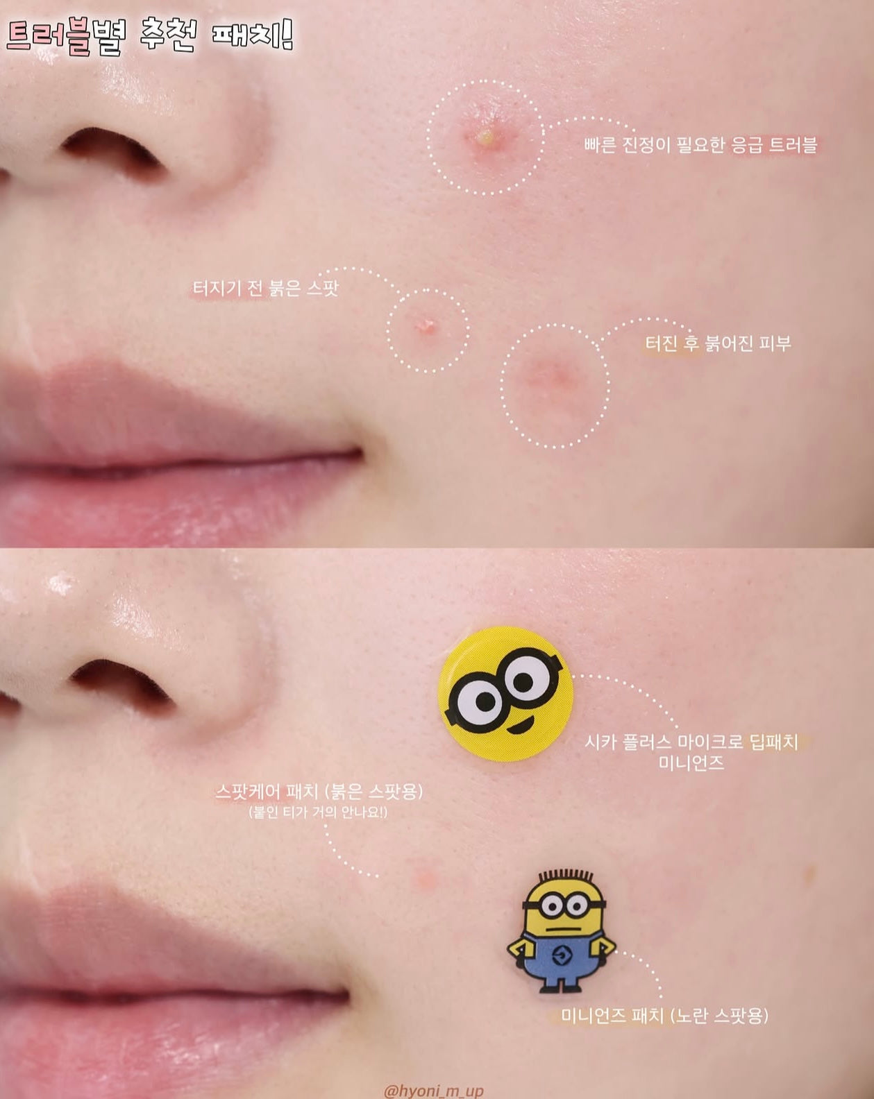 HATHERINE × Minions 的超可愛聯名款痘痘貼！科研級痘痘急救貼⭐️