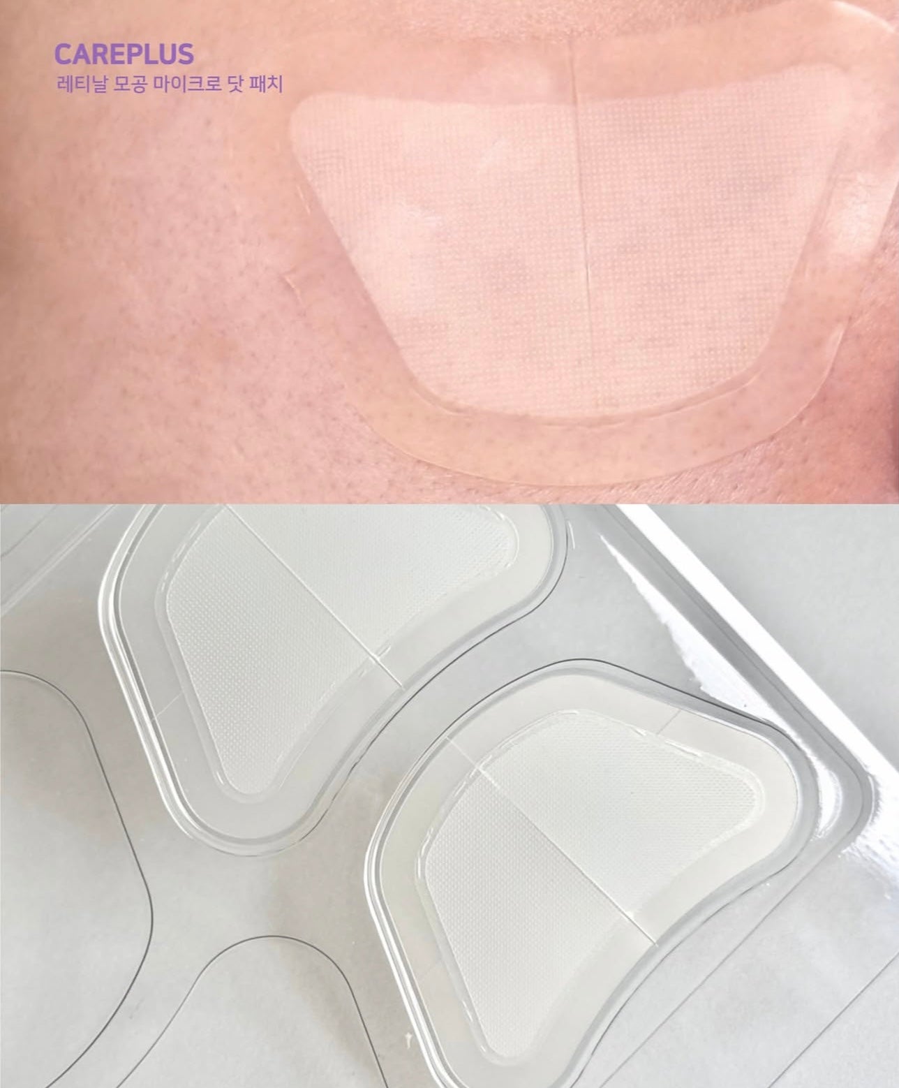 針對毛孔粗大✨CAREPLUS 視黃醇毛孔縮小微針貼片💜| CAREPLUS Retinal Pore Micro Dot Patch