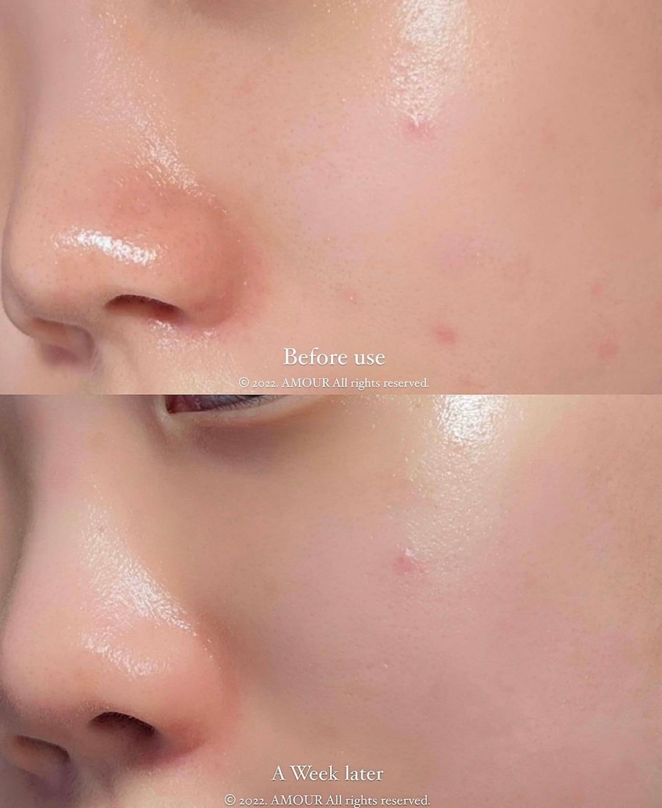 送面霜/爽膚水✨新升級⭐️ Torriden 積雪草控油去痘舒緩精華🌿 | Torriden Balanceful Control Serum| 專為油痘肌敏感肌打造⭐️