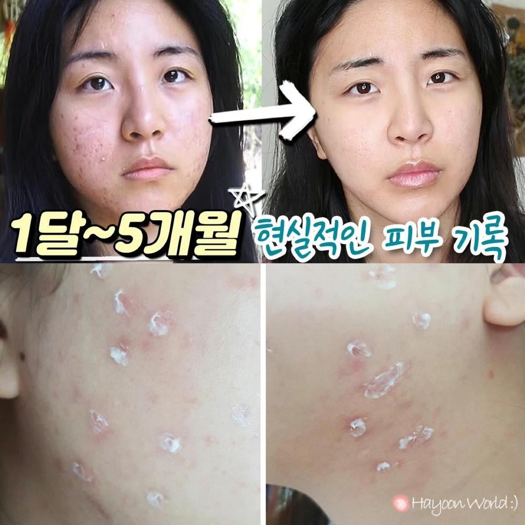 Q Acne祛痘消炎暗瘡膏 | 韓國正規藥商kwangdong藥廠出品🏥